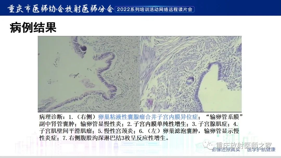 【病例】卵巢黏液性囊腺瘤合并子宫内膜异位1例MR-11