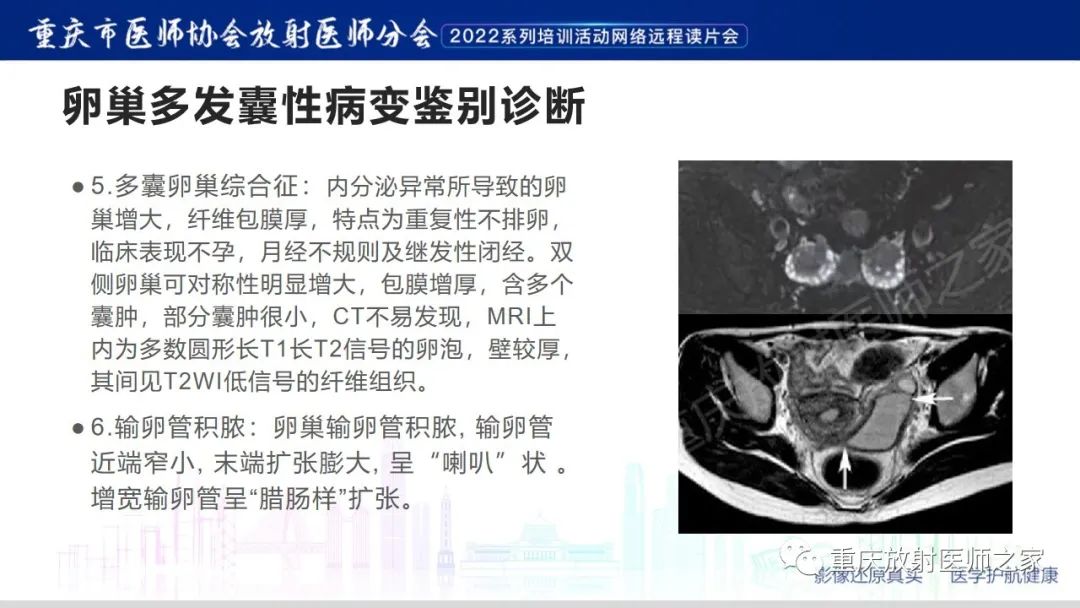 【病例】卵巢黏液性囊腺瘤合并子宫内膜异位1例MR-19