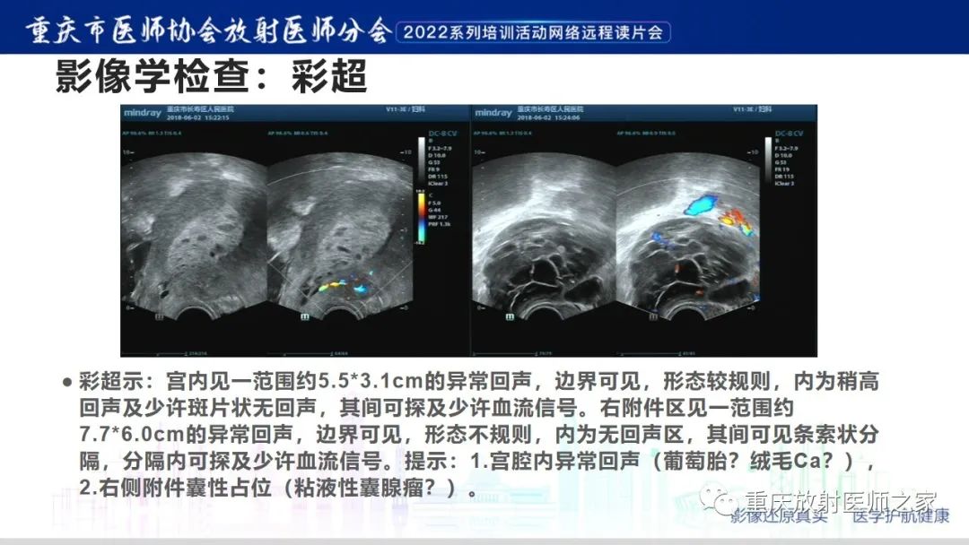【病例】卵巢黏液性囊腺瘤合并子宫内膜异位1例MR-3