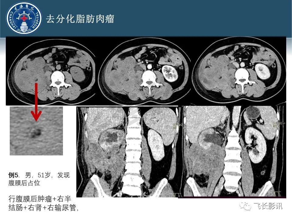 【病例】腹膜后去分化脂肪肉瘤 VS 高分化脂肪肉瘤-47