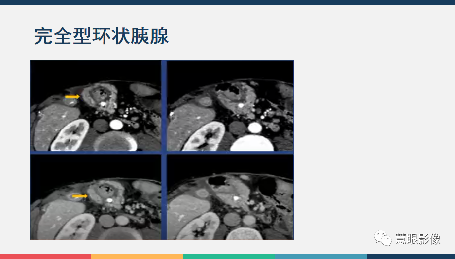 【PPT】胰腺解剖变异、发育异常及相关病变影像评估-27