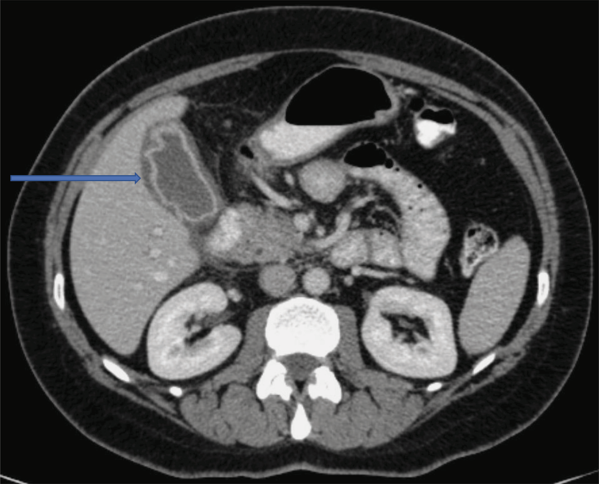 图1-ACUTE ACALCULOUS CHOLECYSTITIS TRIGGERED BY AN ACUTE FLARE-UP IN VIRAL HEPATITIS B INFECTION.png
