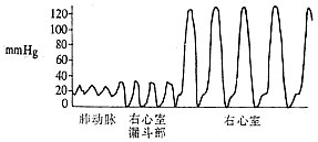 肺动脉狭窄