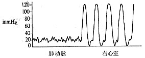 肺动脉口狭窄