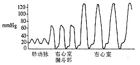 肺动脉狭窄
