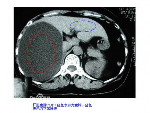 肝囊肿