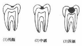 龋齿
