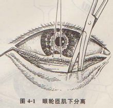 眼轮匝肌 眼轮匝肌
