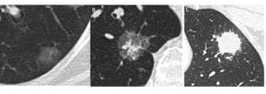 磨玻璃密度结节（ground glass nodule, GGN）、部分实性结节（part-solid nodule）和实性结节（solid nodule）