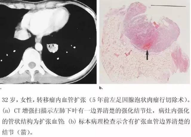 肺转移瘤的13个不典型表现 肺转移瘤的13个不典型表现