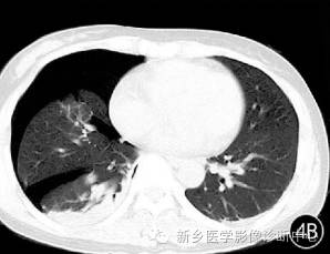 肺撕裂伤原来有四种分型，您知道吗？