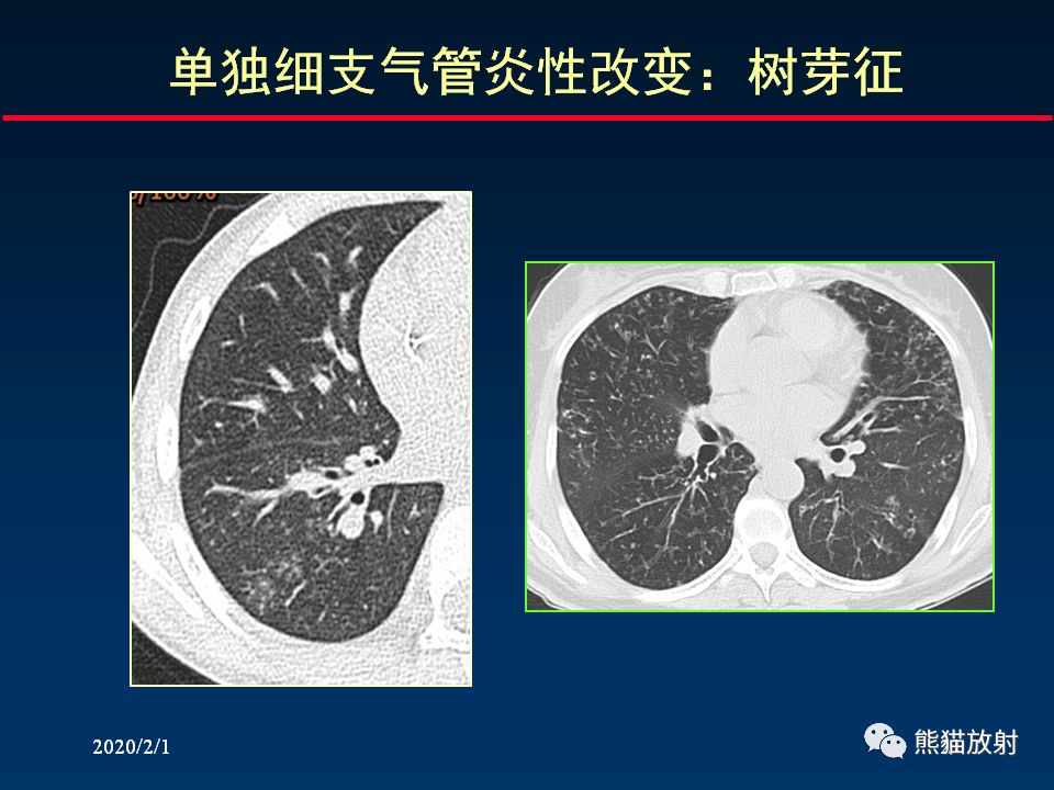 【PPT】精准判读支气管感染的基本CT表现