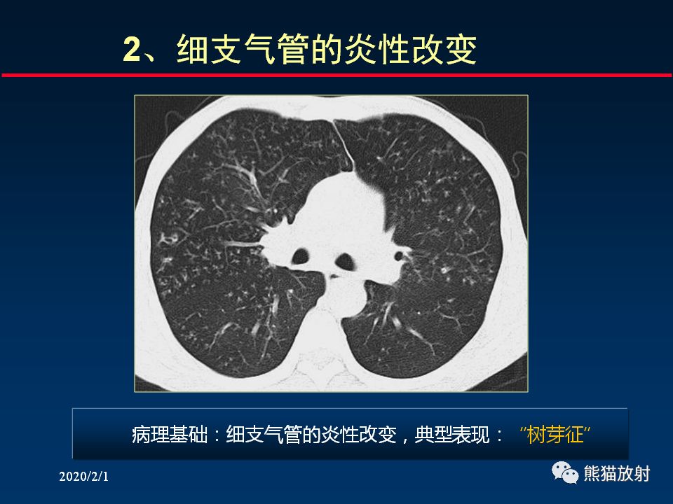 【PPT】精准判读支气管感染的基本CT表现