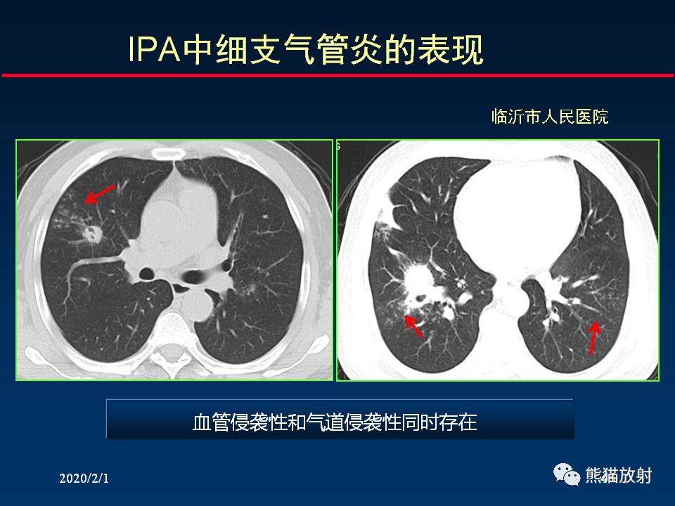 【PPT】精准判读支气管感染的基本CT表现