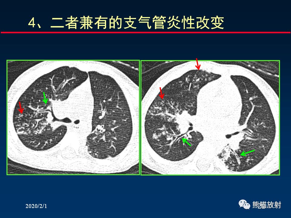 【PPT】精准判读支气管感染的基本CT表现