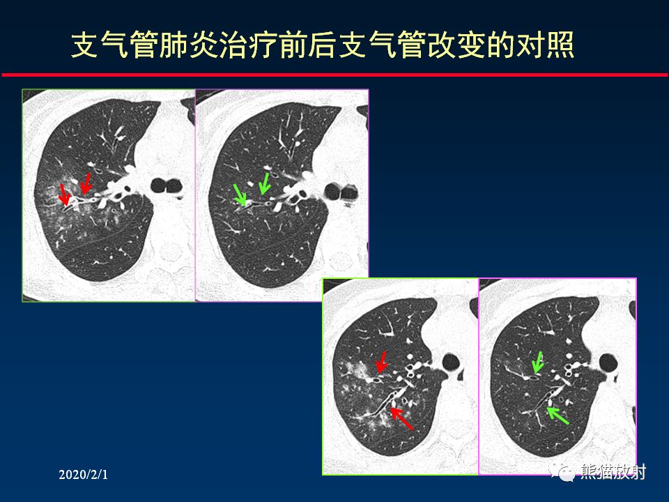 【PPT】精准判读支气管感染的基本CT表现