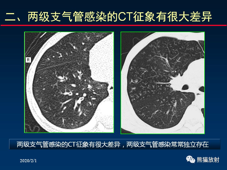 【PPT】精准判读支气管感染的基本CT表现