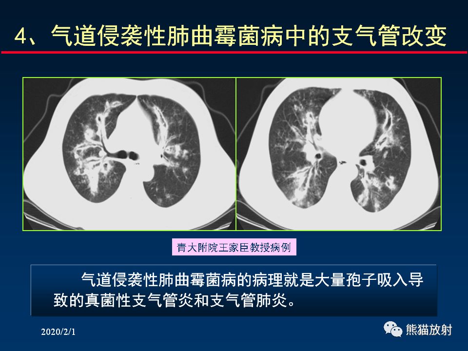 【PPT】精准判读支气管感染的基本CT表现