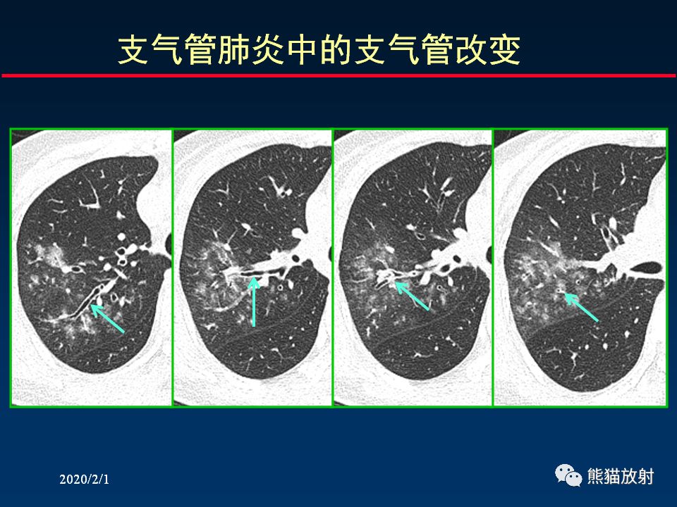 【PPT】精准判读支气管感染的基本CT表现