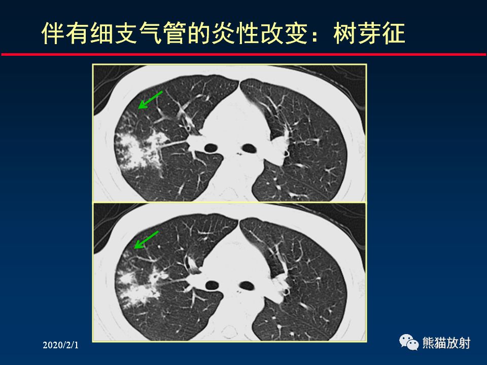 【PPT】精准判读支气管感染的基本CT表现
