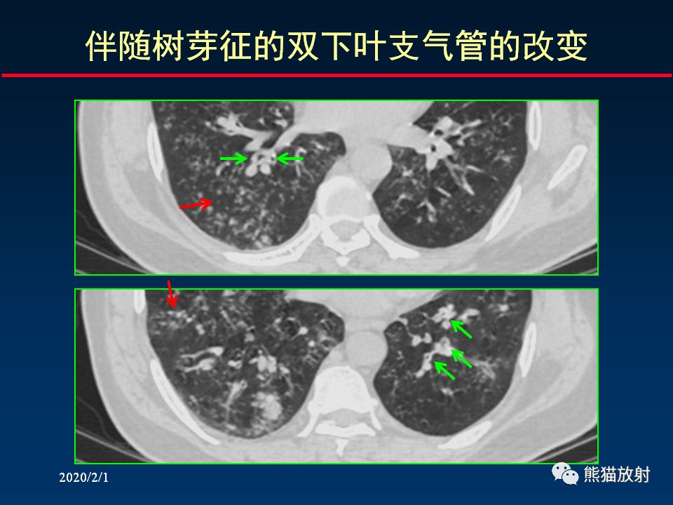 【PPT】精准判读支气管感染的基本CT表现
