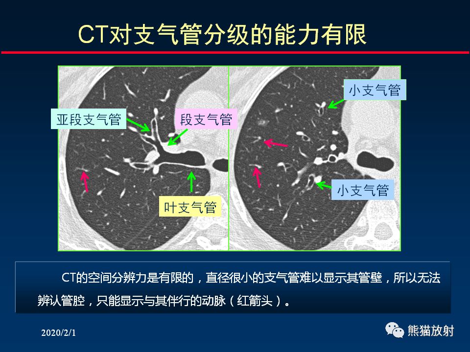 【PPT】精准判读支气管感染的基本CT表现