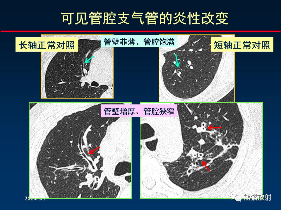 【PPT】精准判读支气管感染的基本CT表现