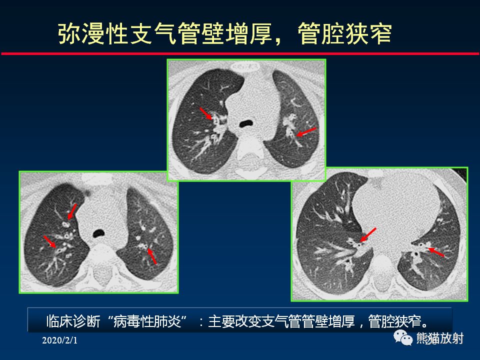 【PPT】精准判读支气管感染的基本CT表现