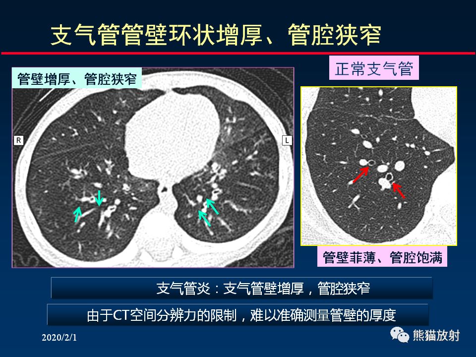 【PPT】精准判读支气管感染的基本CT表现