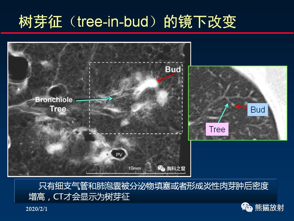 【PPT】精准判读支气管感染的基本CT表现
