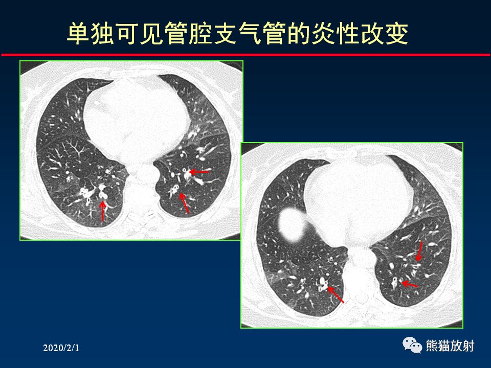 【PPT】精准判读支气管感染的基本CT表现