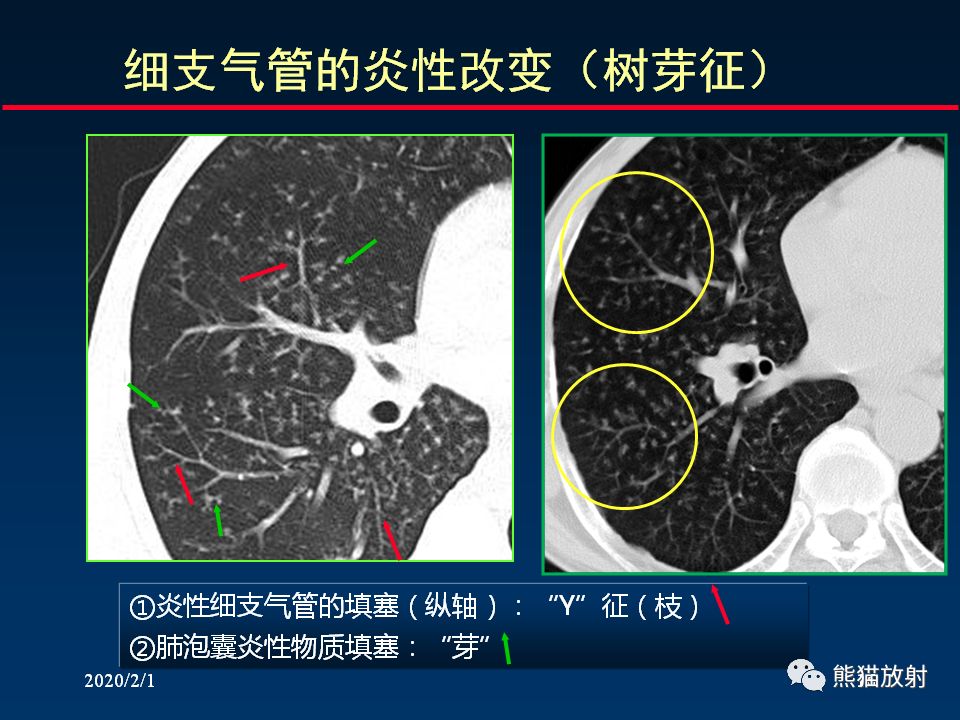 【PPT】精准判读支气管感染的基本CT表现