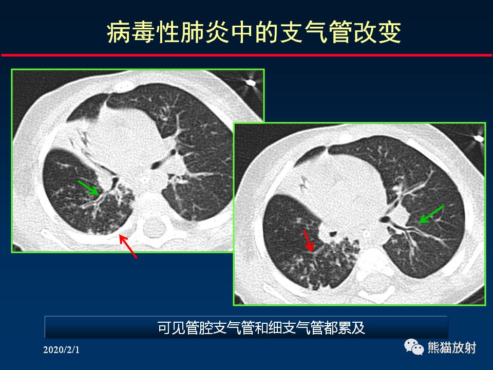 【PPT】精准判读支气管感染的基本CT表现
