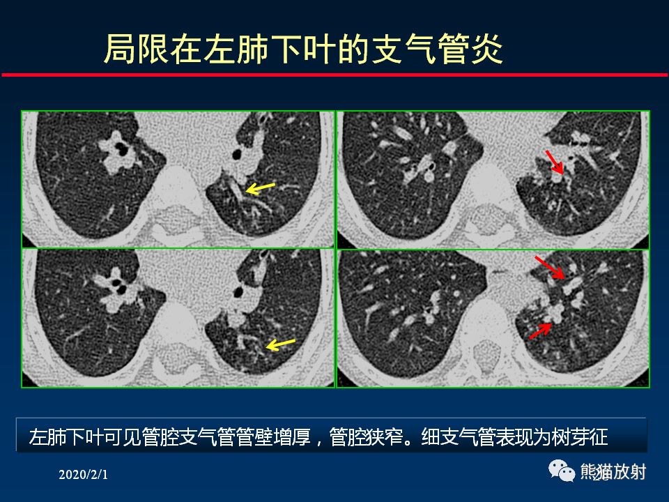 【PPT】精准判读支气管感染的基本CT表现