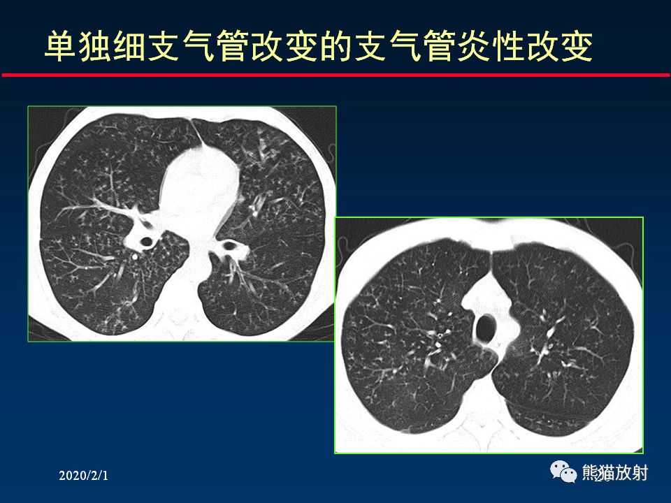 【PPT】精准判读支气管感染的基本CT表现