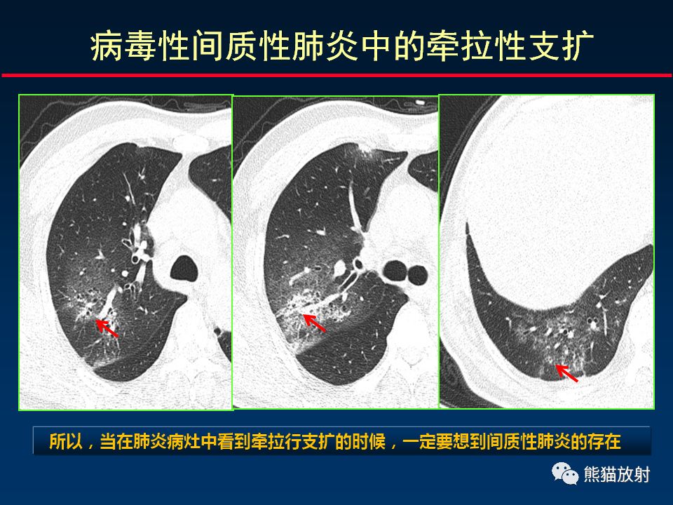 【PPT】精准判读支气管感染的基本CT表现