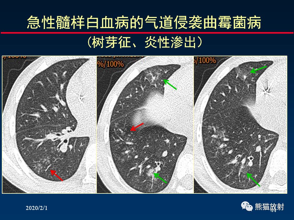【PPT】精准判读支气管感染的基本CT表现