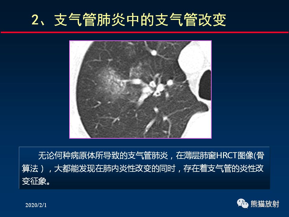 【PPT】精准判读支气管感染的基本CT表现