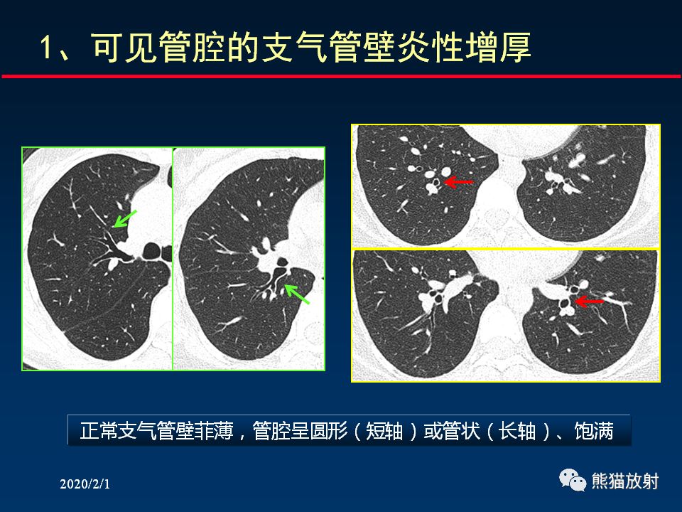 【PPT】精准判读支气管感染的基本CT表现