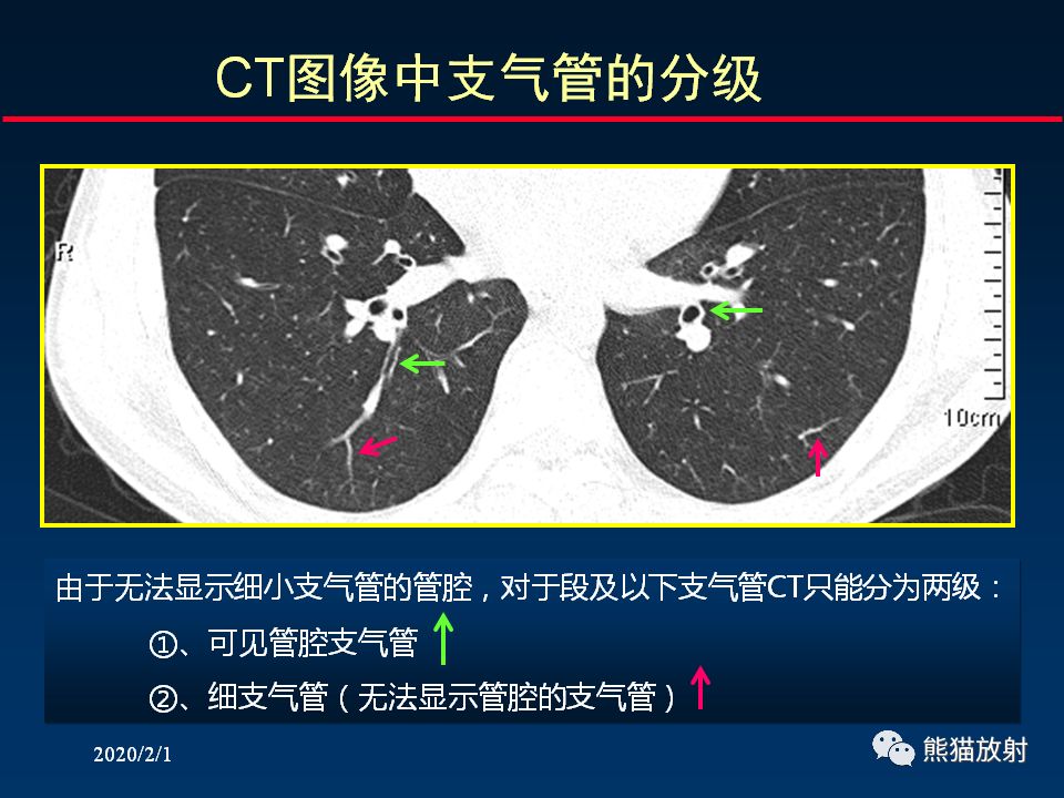 【PPT】精准判读支气管感染的基本CT表现