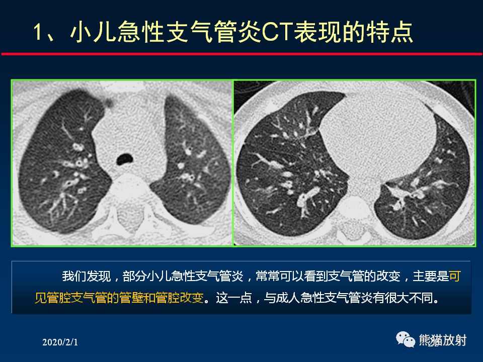 【PPT】精准判读支气管感染的基本CT表现