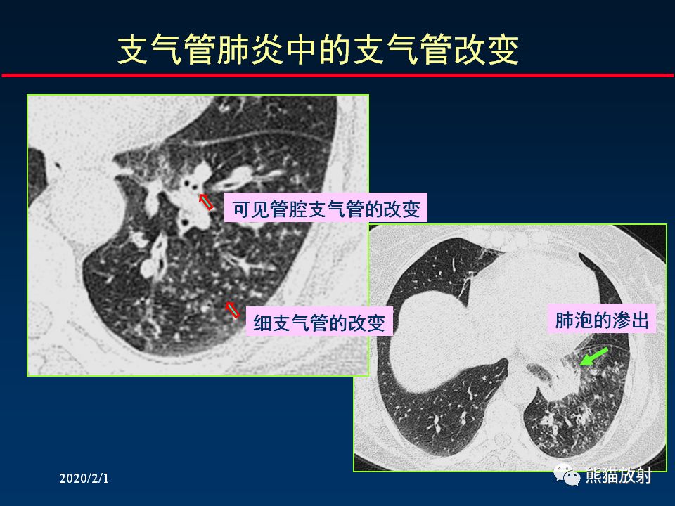 【PPT】精准判读支气管感染的基本CT表现