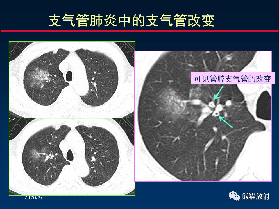【PPT】精准判读支气管感染的基本CT表现