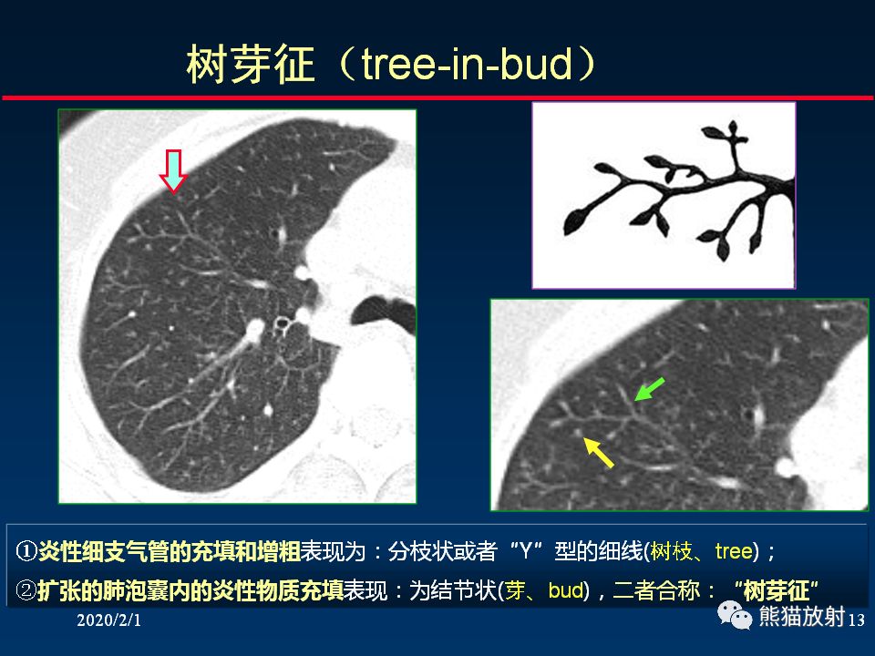 【PPT】精准判读支气管感染的基本CT表现