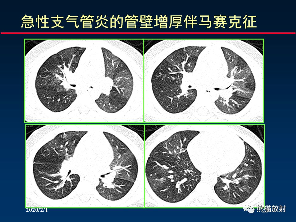 【PPT】精准判读支气管感染的基本CT表现