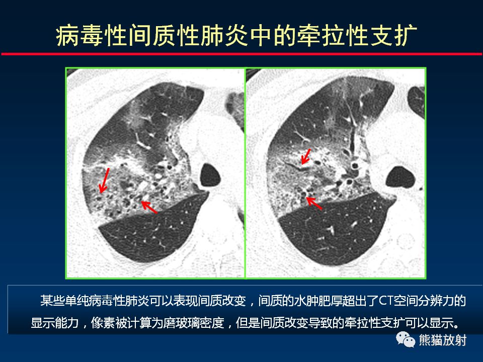 【PPT】精准判读支气管感染的基本CT表现
