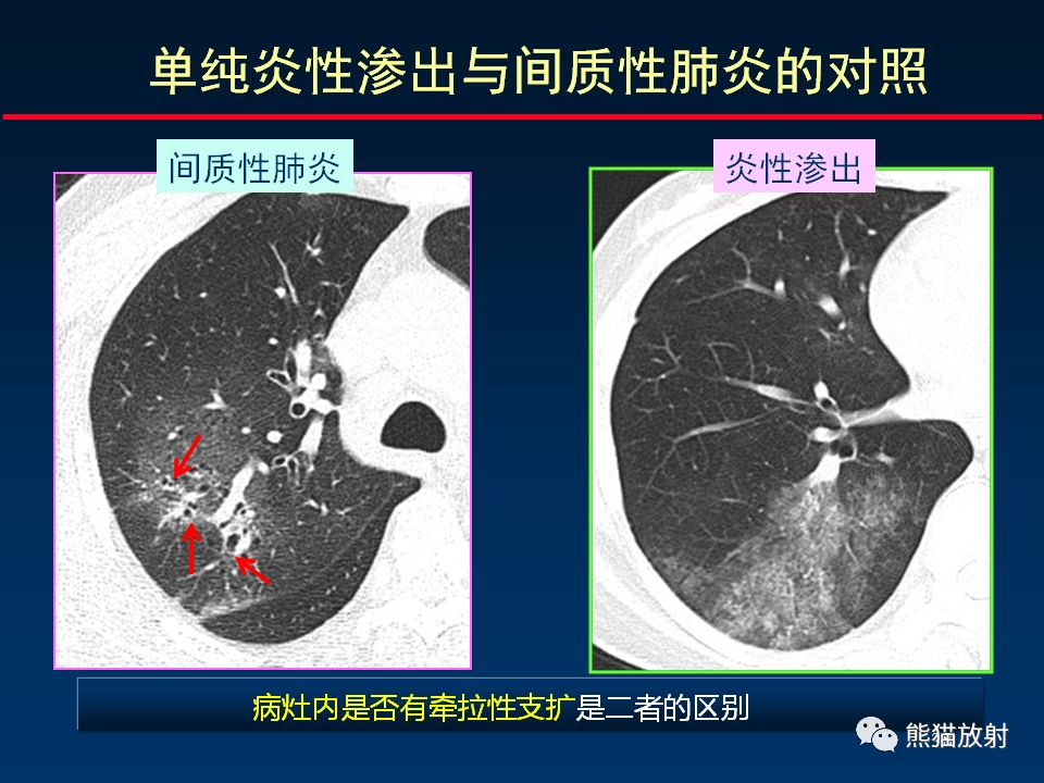 【PPT】精准判读支气管感染的基本CT表现