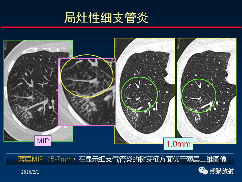 【PPT】精准判读支气管感染的基本CT表现