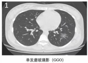 新冠肺炎单发磨玻璃影