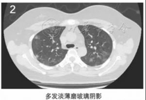 新冠肺炎多发外周带磨玻璃阴影